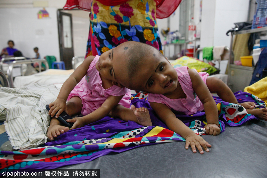 孟加拉國連頭嬰兒 至少到兩歲才能進(jìn)行手術(shù)